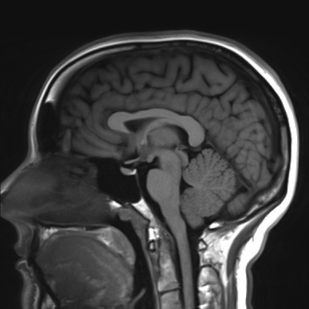 normal brain mri