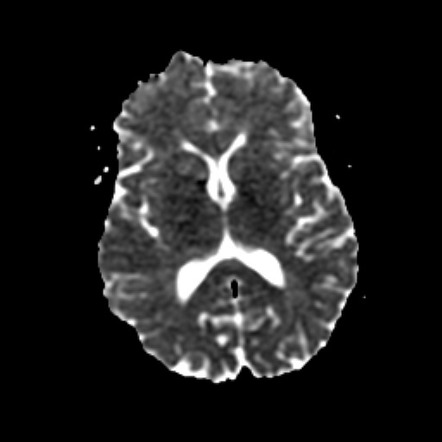 Intracranial hypertension (pseudotumor cerebri) | Image | Radiopaedia.org