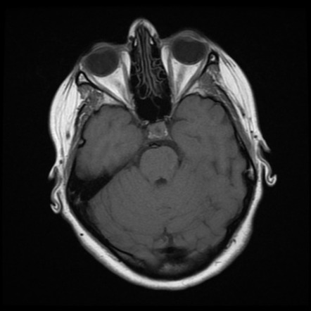 Intracranial hypertension (pseudotumor cerebri) | Image | Radiopaedia.org