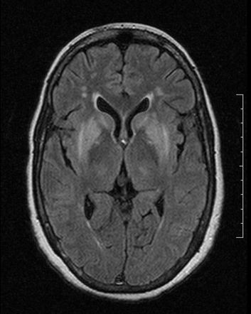 Osmotic demyelination syndrome | Radiology Reference Article ...