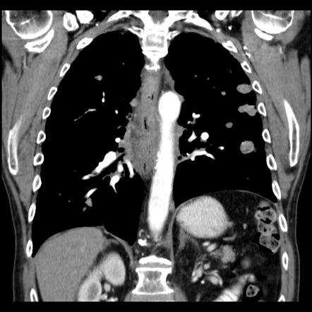 Oesophageal carcinoma | Radiology Reference Article | Radiopaedia.org