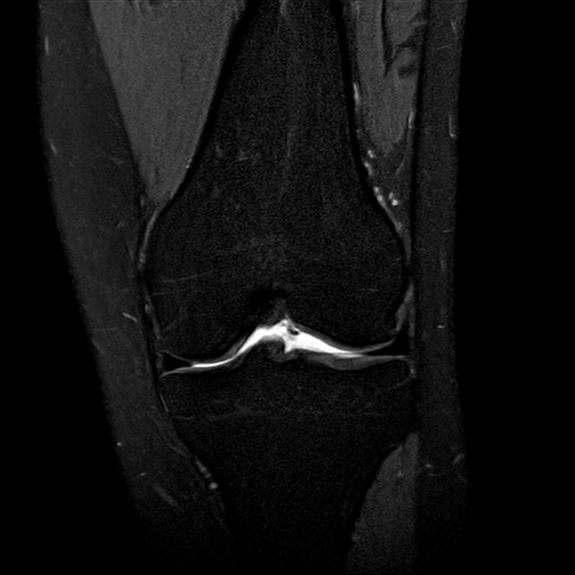 Development of a buckethandle lateral meniscus tear Image