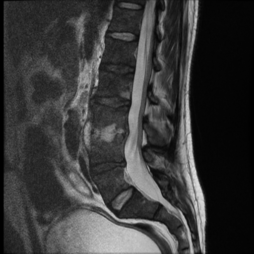 Spondylodiscitis | Image | Radiopaedia.org