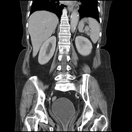 Cystocele Radiology Reference Article Radiopaedia Org