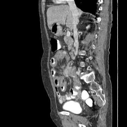 Carcinoid tumor with liver metastases | Image | Radiopaedia.org