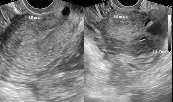 case presentation of ectopic pregnancy