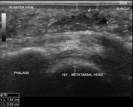 Submetatarsal bursitis | Image | Radiopaedia.org