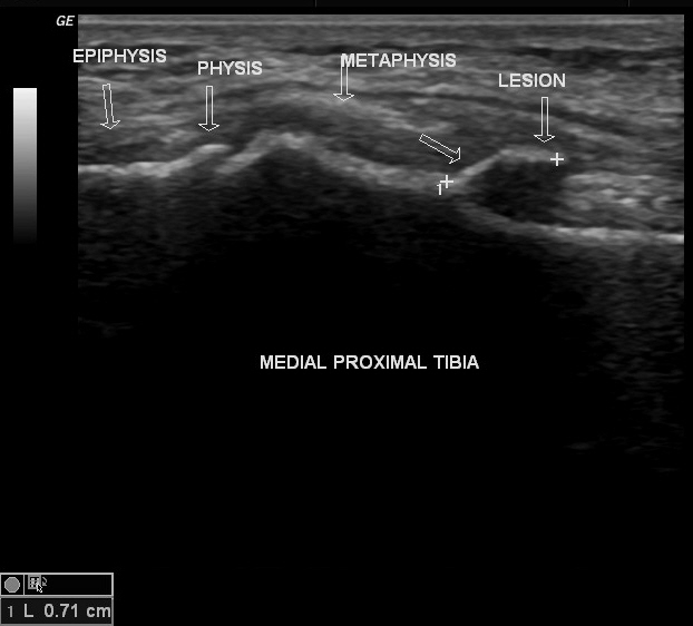 Exostosis Off Tibia Musculoskeletal Case Studies