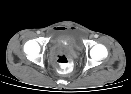 Colorectal carcinoma with recto-vesical fistula | Radiology Case ...