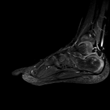 Hypertrophic abductor hallucis muscle | Image | Radiopaedia.org