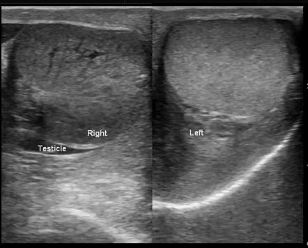 Testicular torsion | Radiology Reference Article | Radiopaedia.org