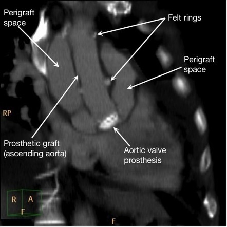 case study bentall procedure