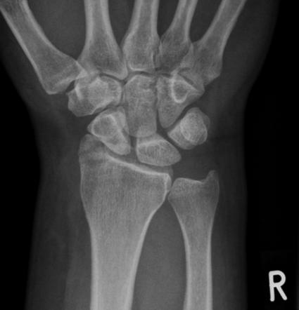 Chauffeur fracture | Radiology Reference Article | Radiopaedia.org