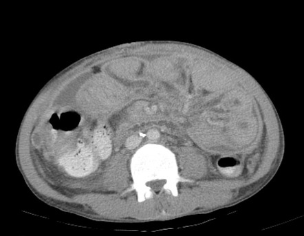 Peritonitis with abdominal cocoon Radiology Case Radiopaedia