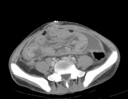 Encapsulating peritoneal sclerosis | Radiology Reference Article ...