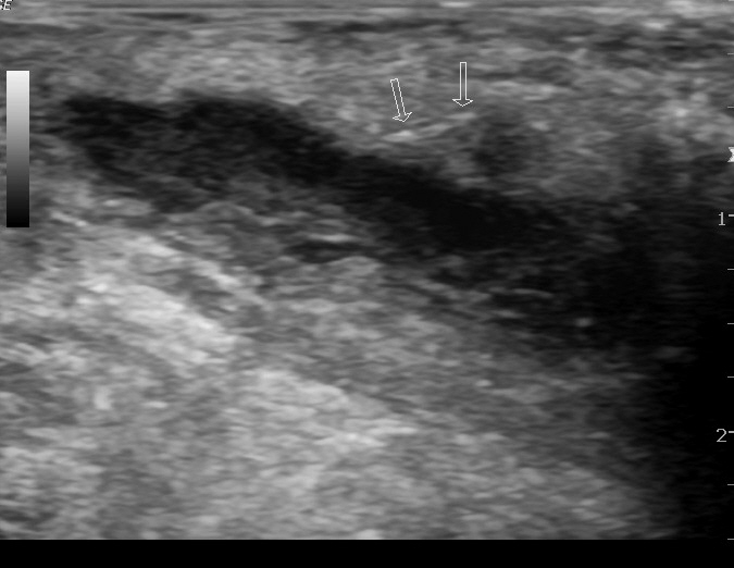 Pilonidal Sinus With Abscess Formation | Image | Radiopaedia.org