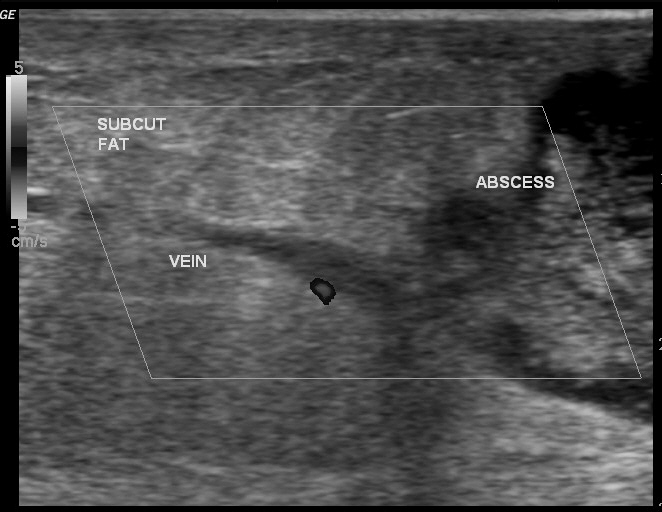 Anterior Abdominal Wall Abscess Image 7800