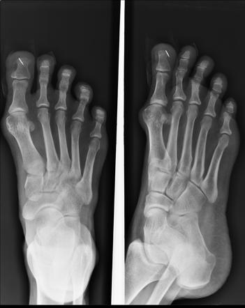 Foreign body in great toe | Radiology Case | Radiopaedia.org