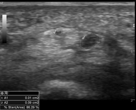 Bifid median nerve | Radiology Case | Radiopaedia.org