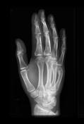 Boxer Fracture Radiology Reference Article Radiopaedia Org