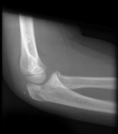 Olecranon and radial head fracture | Radiology Case | Radiopaedia.org