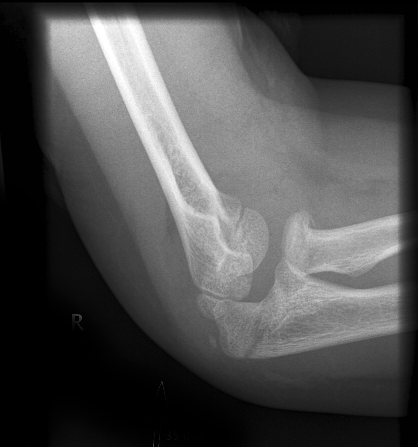 left olecranon fracture