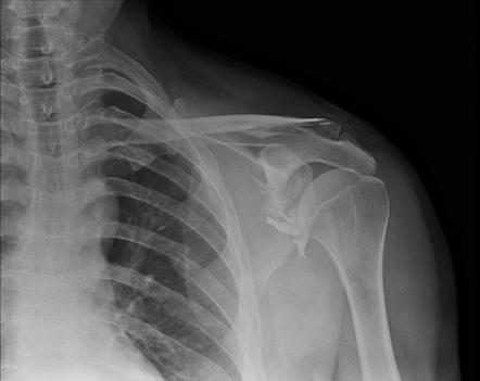 Scapular and clavicular fractures | Radiology Case | Radiopaedia.org