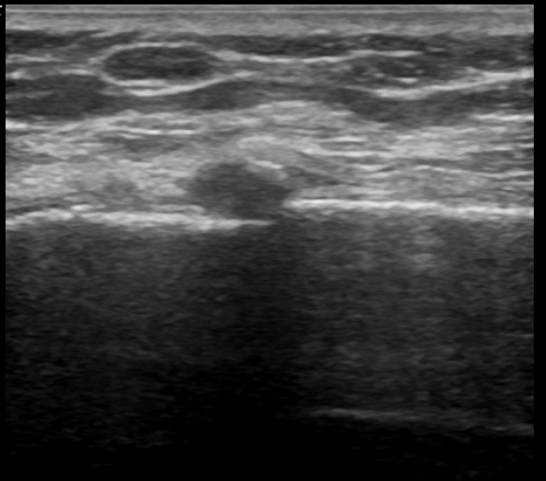 Sternal fracture | Image | Radiopaedia.org