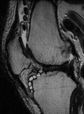 Secondary synovial chondromatosis | Radiology Case | Radiopaedia.org