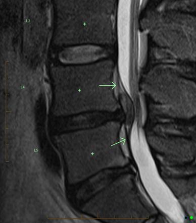 Extruded lumbar disc fragment: penetrating the posterior longitudonal ...