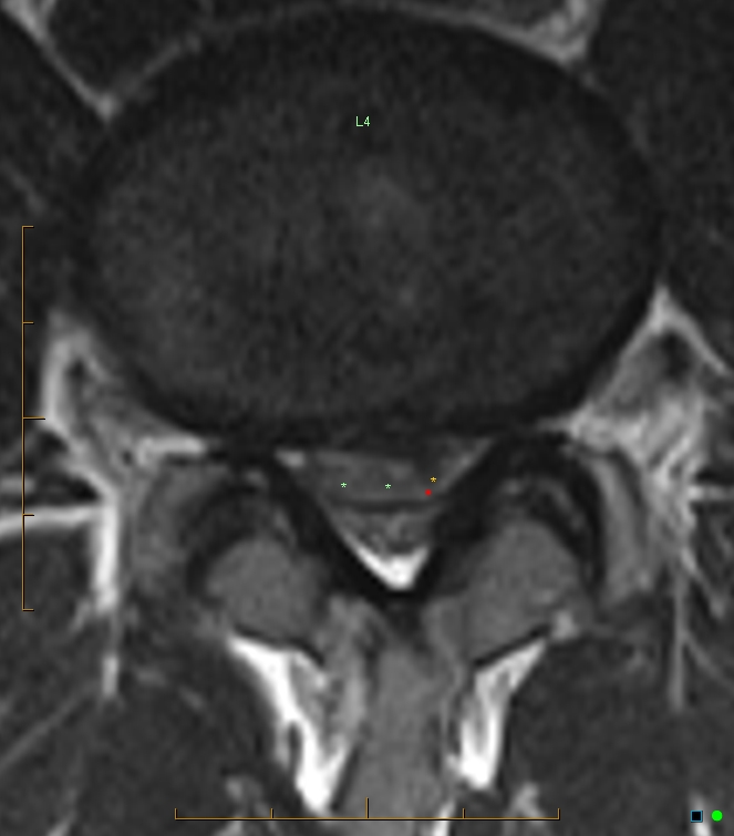 Extruded Lumbar Disc Fragment: Penetrating The Posterior Longitudonal 