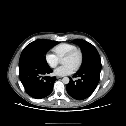 Post primary tuberculosis | Image | Radiopaedia.org