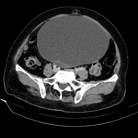 Ovarian serous cystadenoma | Radiology Case | Radiopaedia.org