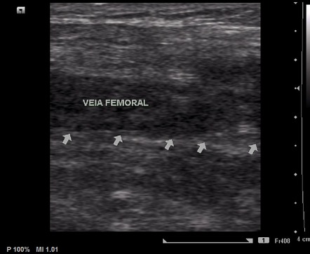 Deep vein thrombosis of lower extremity | Image | Radiopaedia.org