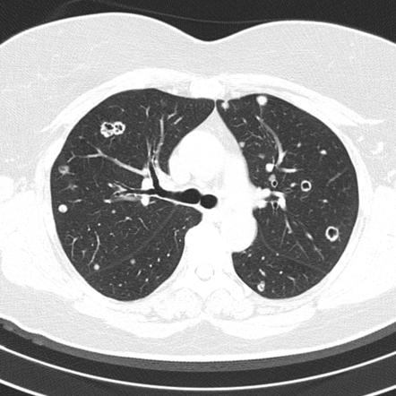 metastases pulmonary cavitating emboli septic radiology radiopaedia nodules differential