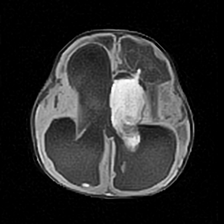 Grade Iv Germinal Matrix Haemorrahge With Intraventricular Extension And Hydrocephalus Image