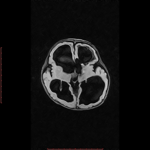 Grade Iv Germinal Matrix Haemorrahge With Intraventricular Extension