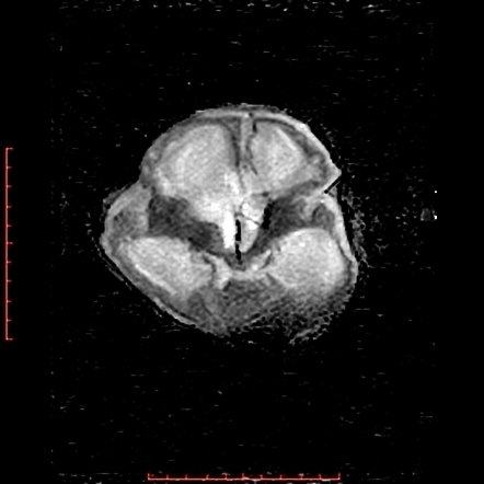 Grade Iv Germinal Matrix Haemorrahge With Intraventricular Extension And Hydrocephalus Image