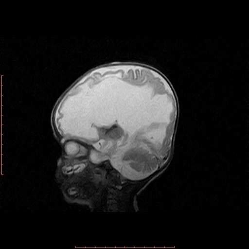 Grade Iv Germinal Matrix Haemorrahge With Intraventricular Extension