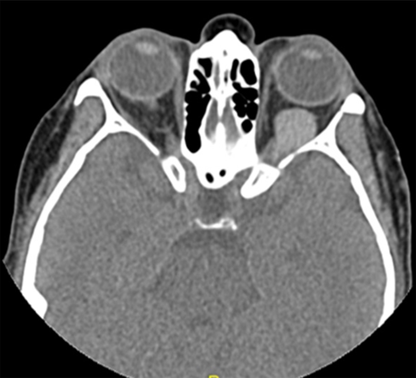 Thrombosed orbital varix | Image | Radiopaedia.org