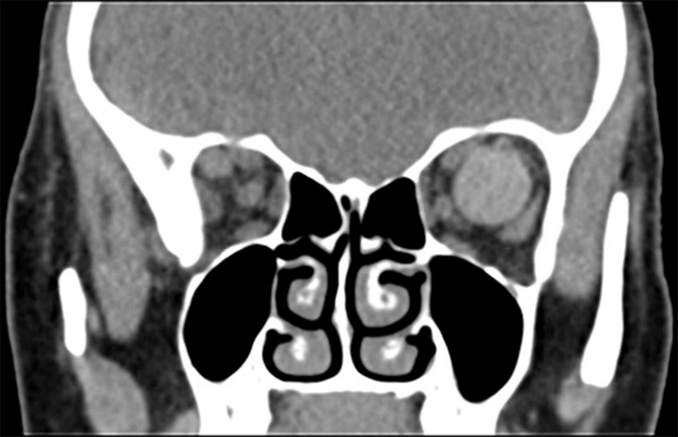 Thrombosed Orbital Varix 