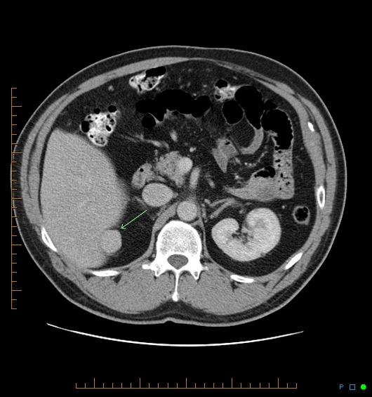 Splenosis | Image | Radiopaedia.org