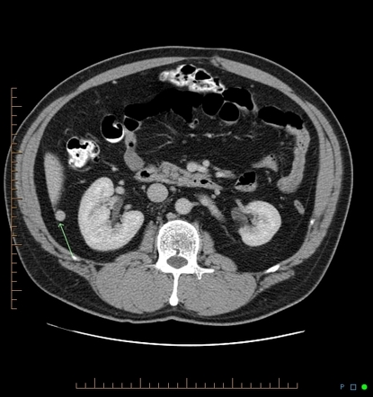 Splenosis | Image | Radiopaedia.org