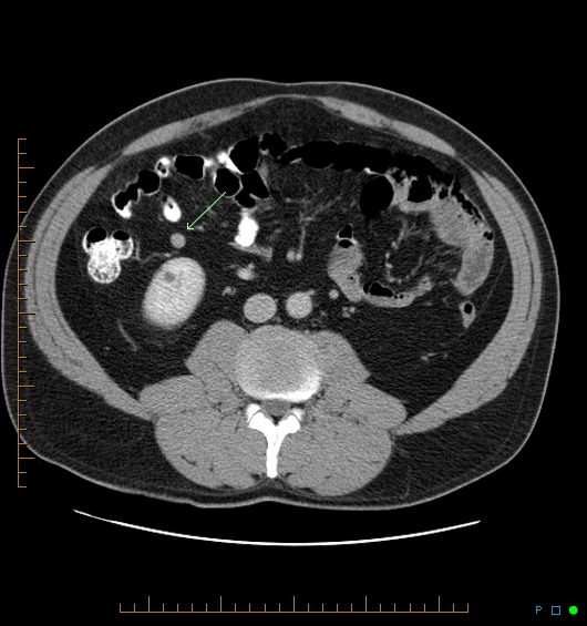 Splenosis | Image | Radiopaedia.org