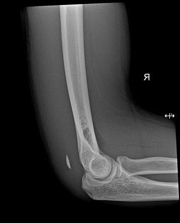 Triceps bony avulsion | Radiology Reference Article | Radiopaedia.org