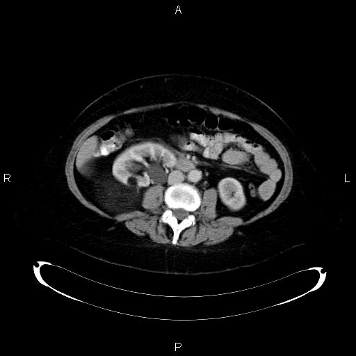 Exophytic Renal Angiomyolipoma Image