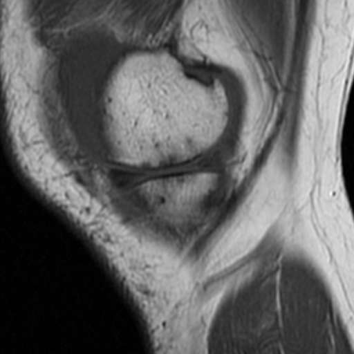 Meniscal flap tear | Image | Radiopaedia.org