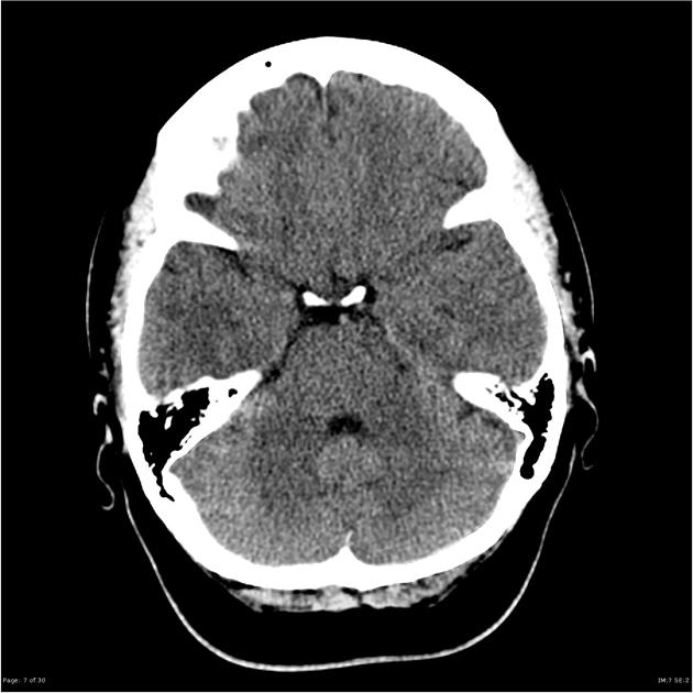 Benign hypertension online