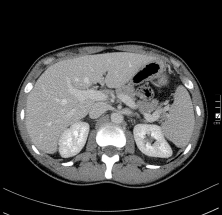 Nutcracker syndrome | Radiology Reference Article | Radiopaedia.org