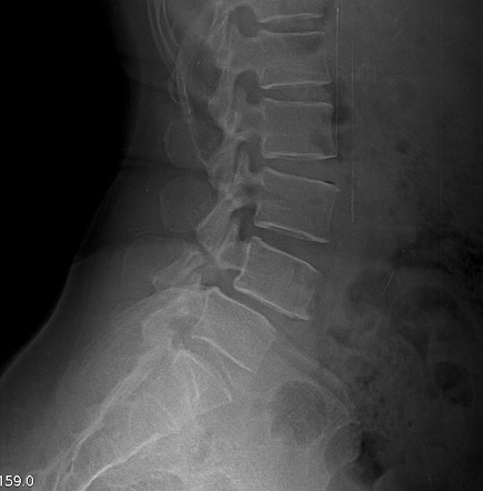 Scottie dog sign (spine) | Radiology Reference Article | Radiopaedia.org